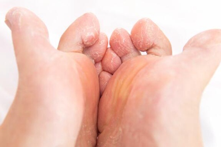 有脚气怎么办快速解决?这五个治疗方法解决脚困扰