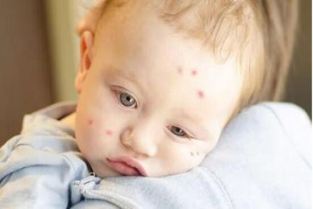 如何预防蚊子咬宝宝，试试下面的方法