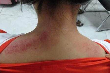 女性治疗鼻炎，只需要记住这一招