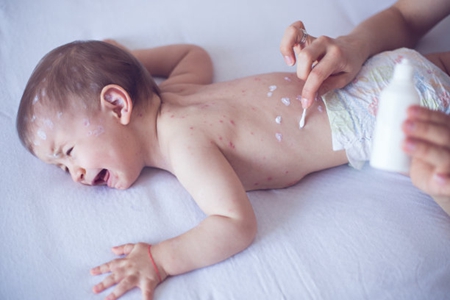 水痘的症状和治疗，这三个出水痘的症状宝妈要注意