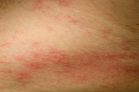 皮肤过敏不能吃什么？这五种皮肤过敏忌口食物一览