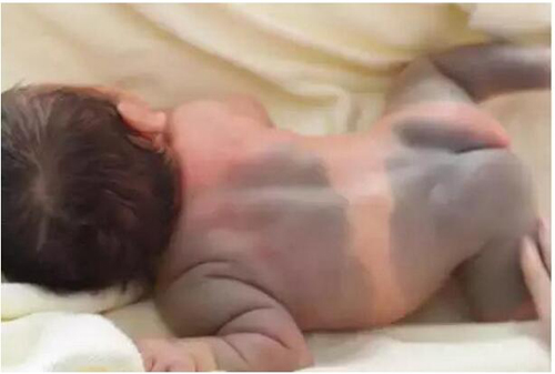 宝宝胎记是怎么形成的