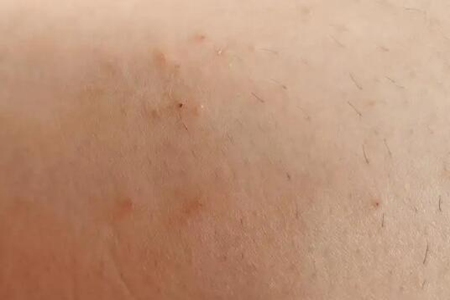 腿上长了红色的小点点是怎么回事?这五个病因及时治疗改善