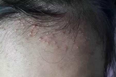 夏天宝宝长痱子怎么办?宝妈们预防小妙招