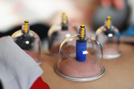 拔火罐的好处和坏处,拔火罐的这3点知识要知道