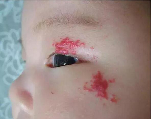 宝宝胎记是怎么形成的