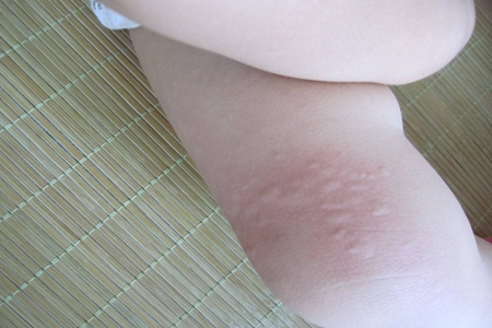 儿童皮肤过敏的治疗和预防，宝妈们注意皮肤过敏药