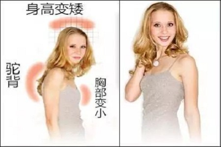女性圆肩 驼背,立马会让你矮5厘米