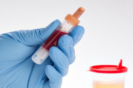 小便时尿出血是怎么回事？这五个原因造成得警惕泌尿肿瘤