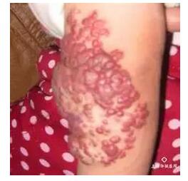 宝宝胎记是怎么形成的