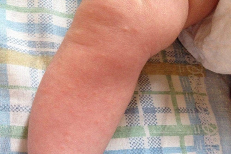 儿童皮肤过敏的治疗和预防，宝妈们注意皮肤过敏药