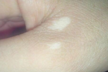 我的手上有白斑是什么?这四个原因引发及时治疗改善