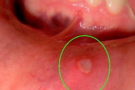 经常口腔溃疡是什么原因?这五个因素导致得及时改善治疗