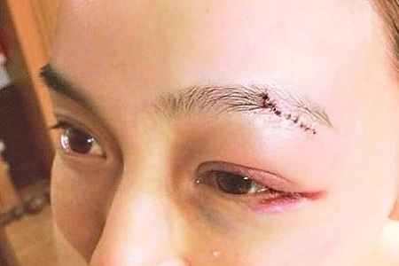 范玮琪摔倒下巴缝15针,网友吐槽:绝对的摔倒专业户