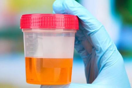 小便时尿出血是怎么回事？这五个原因造成得警惕泌尿肿瘤