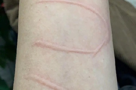 皮肤划痕症要怎么解决？慢性荨麻疹根除大揭秘