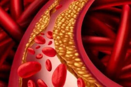 血管堵塞的症状有哪些?这4个症状说明血管已堵塞