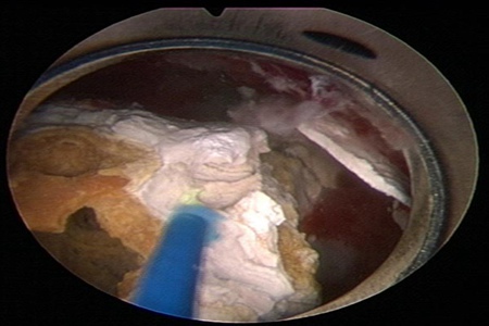 激光碎石有什么用？激光碎石后需要注意什么？