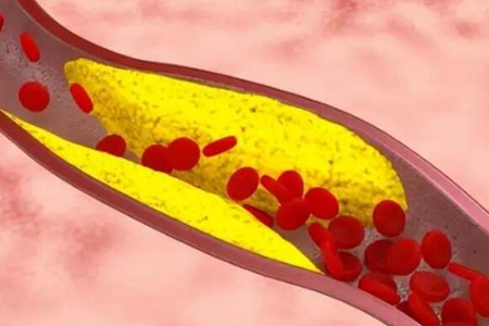 血管堵塞的症状有哪些?这4个症状说明血管已堵塞