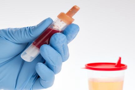 尿血是什么原因？这五个因素引发赶快对症下药