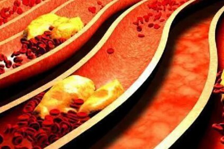 血管堵塞的症状有哪些?这4个症状说明血管已堵塞