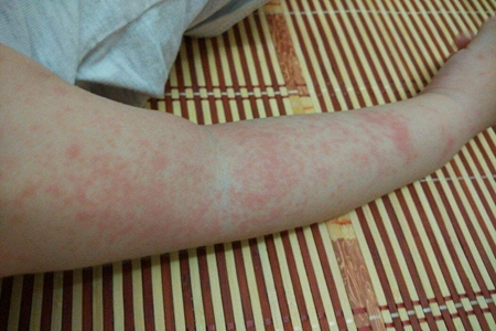 夏天宝宝长痱子怎么办?宝妈们预防小妙招