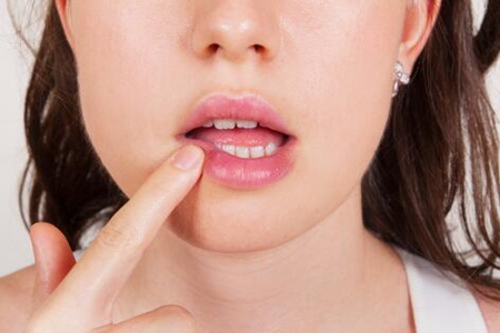 口腔溃疡是什么原因造成?这五个幕后黑手诱发溃疡症状