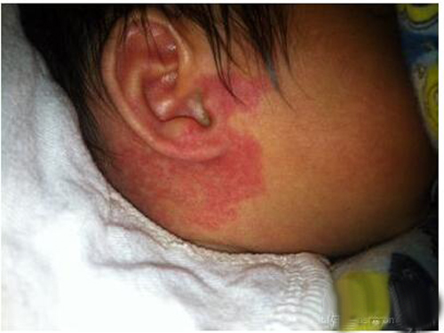 宝宝胎记是怎么形成的