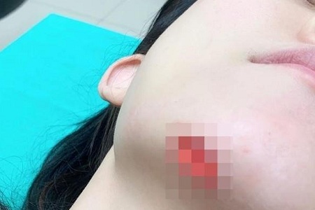 范玮琪摔倒下巴缝15针,网友吐槽:绝对的摔倒专业户