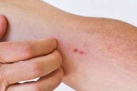 过敏性皮炎是什么原因引起的?这五个原因要从衣食住行改善