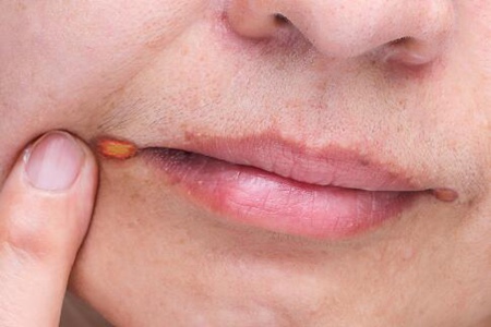 唇炎的症状有哪些?这五个因素及时改善治疗
