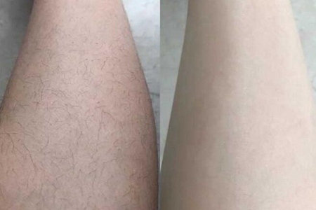 怎么去腿毛最有效?这三个女生去腿毛的方法