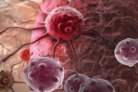 胃癌是什么原因引起的?这五个原因造成及时改善