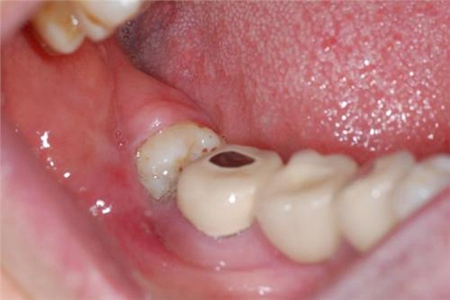 智齿一定要拔吗?这5种情况的智齿一定要拔