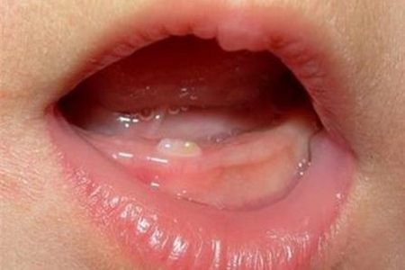 儿童长牙疼怎么缓解疼痛？这三个缓解儿童牙疼小妙招