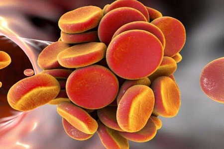 血栓是怎么形成和引起的？这四个因素有着极为密切的联系