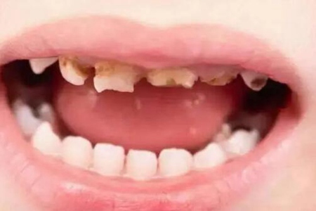 儿童牙痛怎么办?这五个应对方法或许能救急